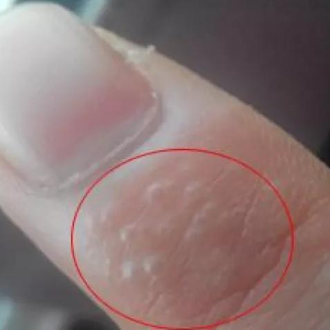 脚上起小水泡还很痒是怎么回事?一文读懂原因与应对方法 脚上起小水泡还很痒是怎么回事?一文读懂原因与应对方法