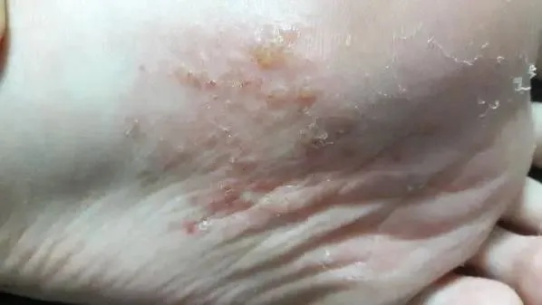 脚上起小水泡还很痒?别忽视,这几种常见原因在作怪 脚上起小水泡还很痒?别忽视,这几种常见原因在作怪
